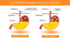 Gastroesophageal reflux disease, gastroesophageal reflux disease treatment, Gastro esophageal reflux, what causes heartburn, gastroesophageal reflux disease stomach pain