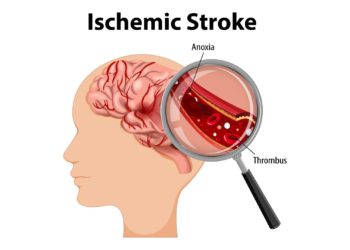 Ischemic stroke, Blood clot in the brain, stroke symptoms in a woman