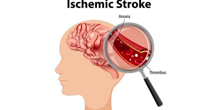 Ischemic stroke, Blood clot in the brain, stroke symptoms in a woman