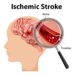 Ischemic stroke, Blood clot in the brain, stroke symptoms in a woman