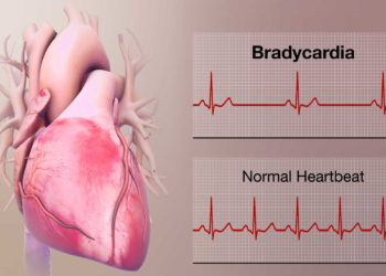 Bradycardia Definition, Bradycardia Signs, Normal Heart Rate of an Adult, Symptoms Of Bradycardia,