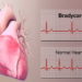 Bradycardia Definition, Bradycardia Signs, Normal Heart Rate of an Adult, Symptoms Of Bradycardia,