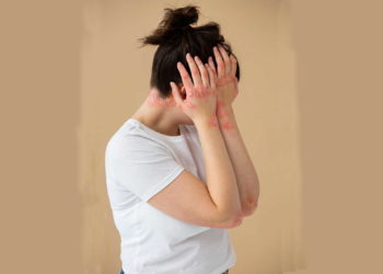 Toxic epidermal necrolysis, Skin Disorder