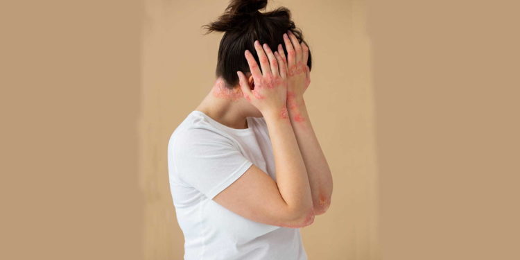 Toxic epidermal necrolysis, Skin Disorder