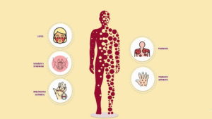 Common variable immunodeficiency, immunodeficiency common variable, common immunodeficiency disease, what is common variable immunodeficiency, immunodeficiency cvid