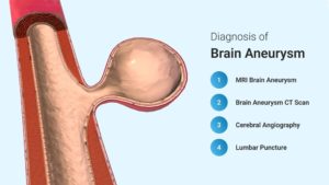 Brain aneurysm, Brain aneurysm symptoms, Brain aneurysm causes, Brain aneurysm how does it happen, can you survive a Brain aneurysm