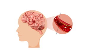 Brain aneurysm, Brain aneurysm symptoms, Brain aneurysm causes, Brain aneurysm how does it happen, can you survive a Brain aneurysm