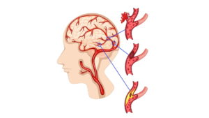 Brain aneurysm, Brain aneurysm symptoms, Brain aneurysm causes, Brain aneurysm how does it happen, can you survive a Brain aneurysm