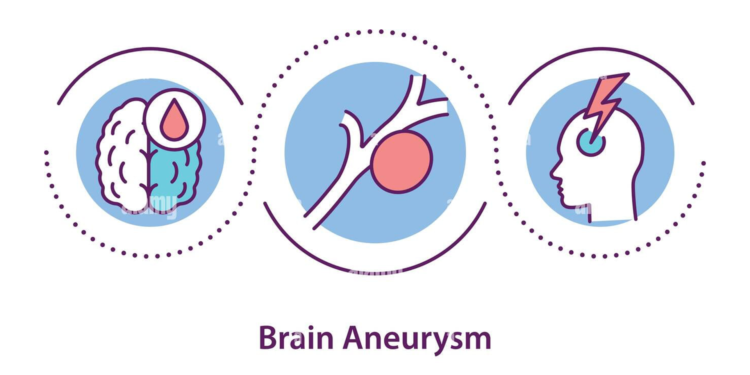 Brain aneurysm, Brain aneurysm symptoms, Brain aneurysm causes, Brain aneurysm how does it happen, can you survive a Brain aneurysm