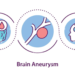 Brain aneurysm, Brain aneurysm symptoms, Brain aneurysm causes, Brain aneurysm how does it happen, can you survive a Brain aneurysm